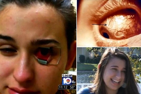 Lensa Kontak Nyaris Bikin Buta Akibat Parasit Gerogoti Kornea